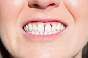 Bleeding Gums