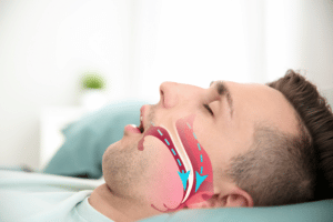 Diagnosing Treating Obstructive Sleep Apnea resized