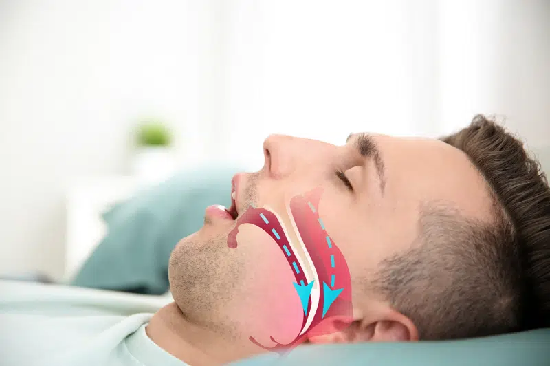 Diagnosing Treating Obstructive Sleep Apnea resized