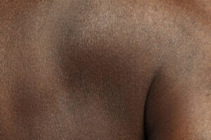Dry Skin Causes Symptoms and the Best Ways to Treat It Naturally and Effectively