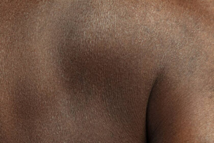 Dry Skin Causes Symptoms and the Best Ways to Treat It Naturally and Effectively