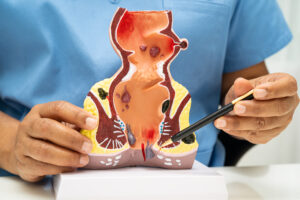 FoodanHealth 18 Hemorrhoids