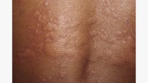Skin allergies