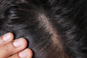 FoodanHealth 17 Dandruff