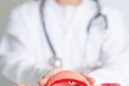 Ovarian cancer