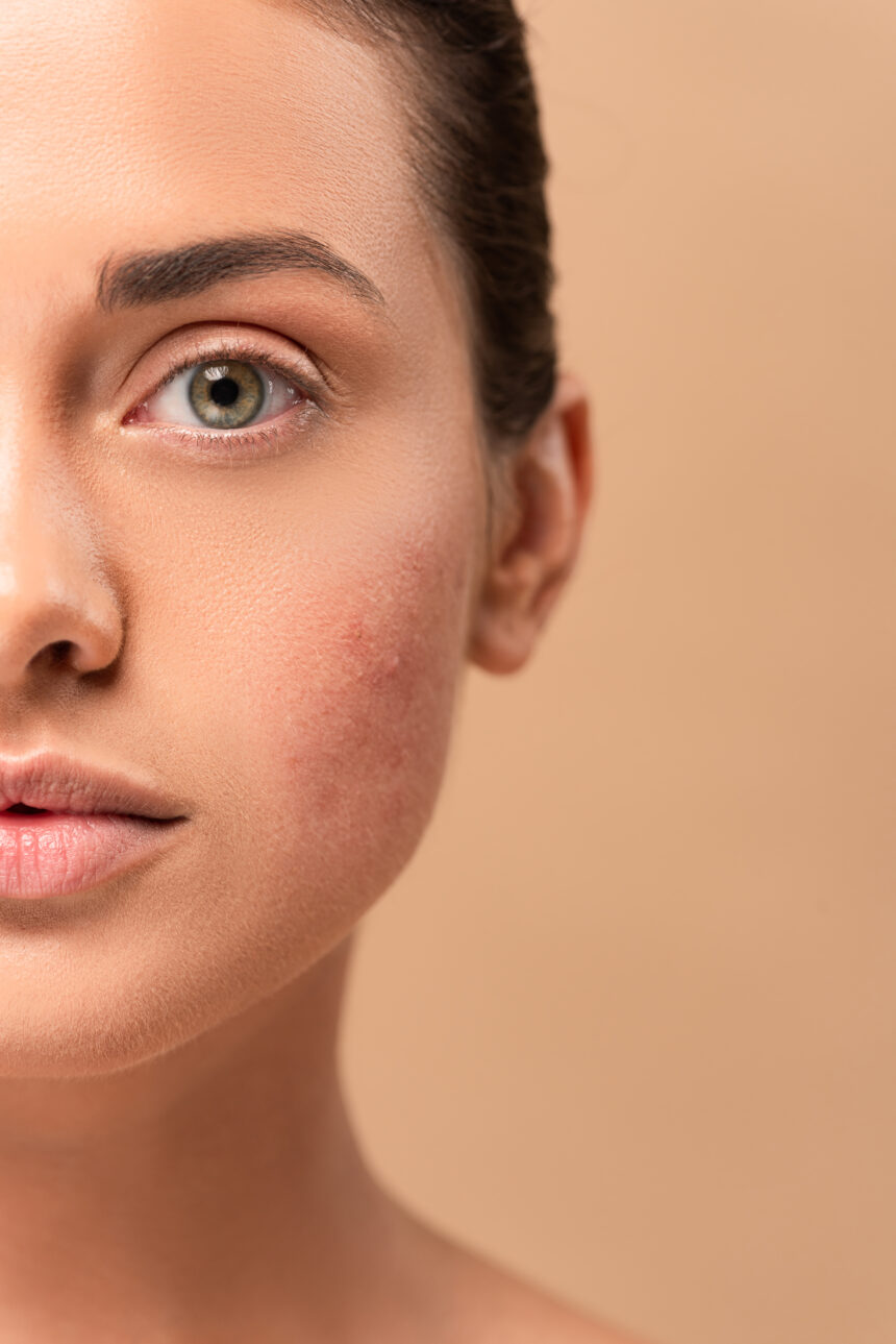 skin barrier