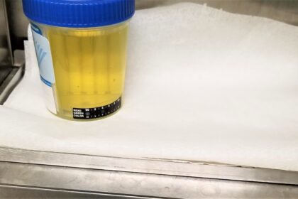 Foamy Urine