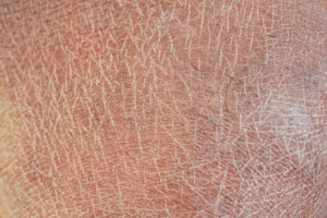 Dry Skin