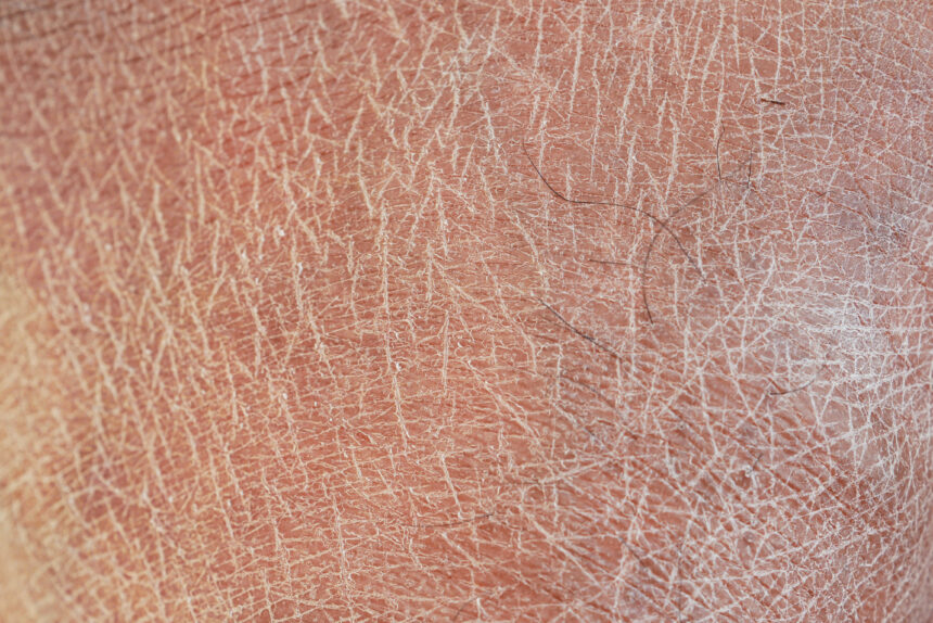 Dry Skin