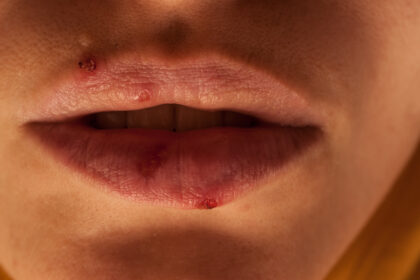 Herpes Simplex Virus HSV