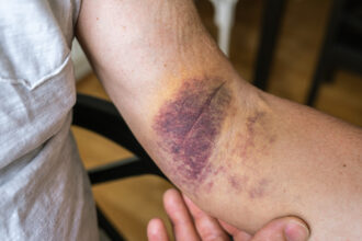 Skin Infection