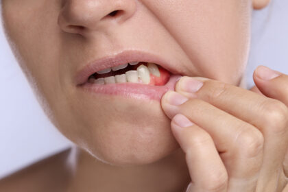 Wound on the Gum