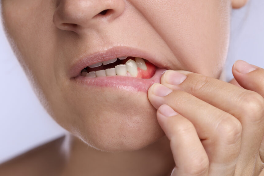 Wound on the Gum
