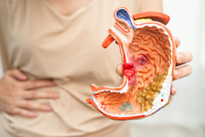 stomach ulcer
