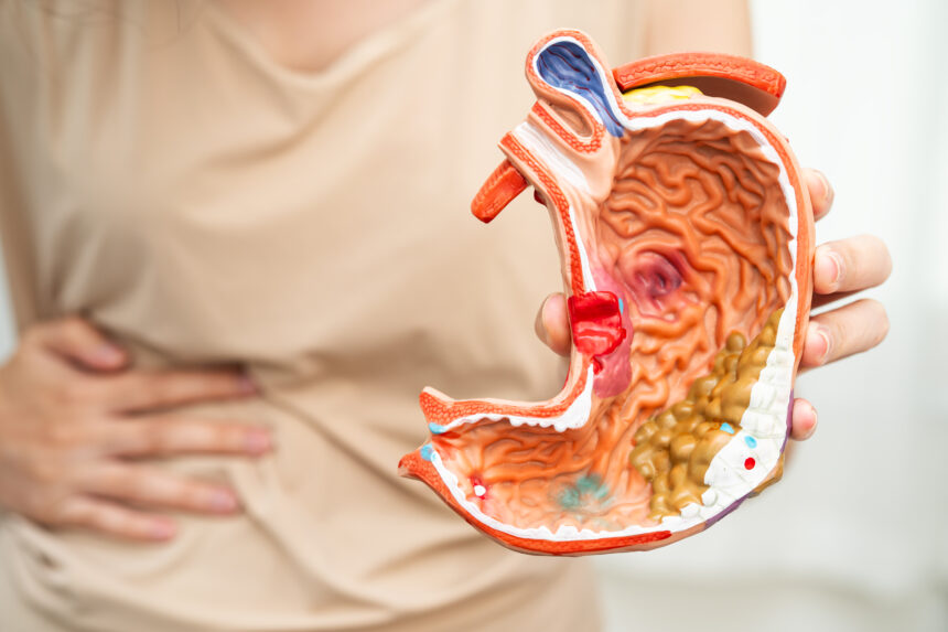 stomach ulcer