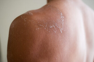 Contact Dermatitis