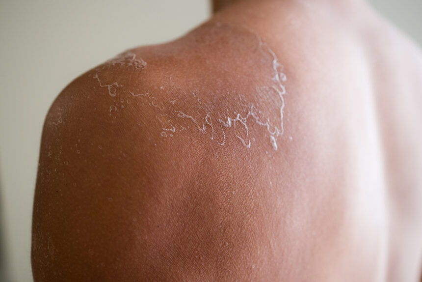 Contact Dermatitis