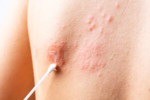 Fungal Infections