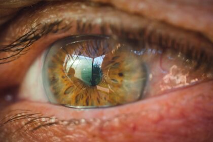 Glaucoma