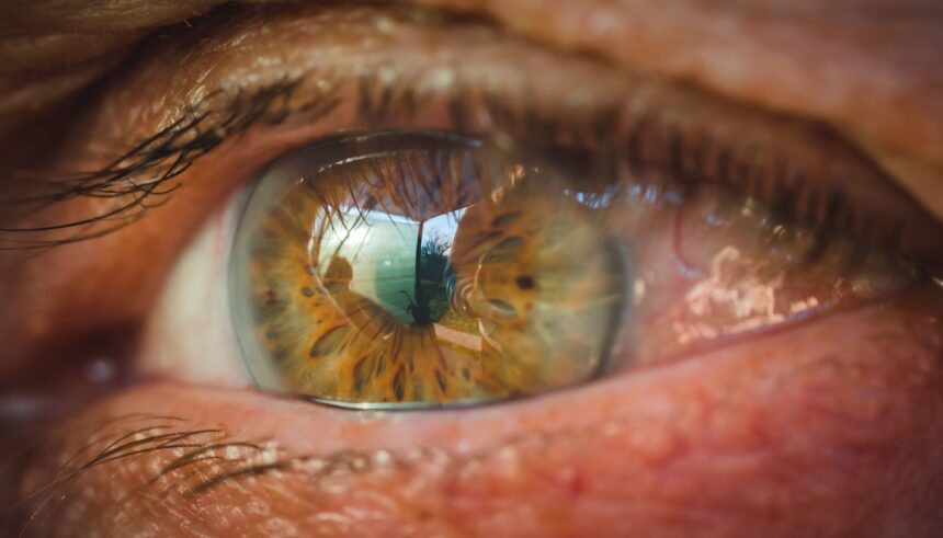 Glaucoma